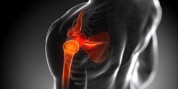 „Zespół cieśni podbarkowej” jako przyczyna bólu stawu ramiennego