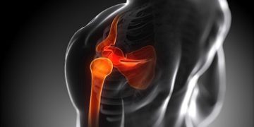 „Shoulder Impingement Syndrome”, the Cause of Shoulder Pain