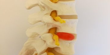 Lumbar Discopathy- Prophylaxis and Treatment